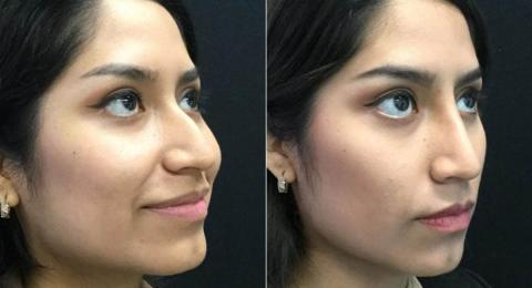 Woman before and after cosmetic surgery on her nose